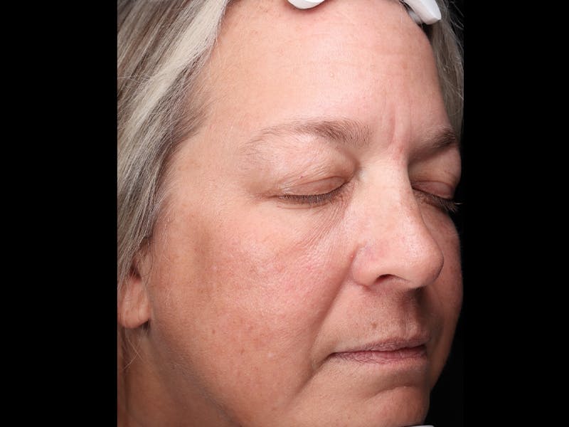 Chemical Peel Before & After Gallery - Patient 367541 - Image 4