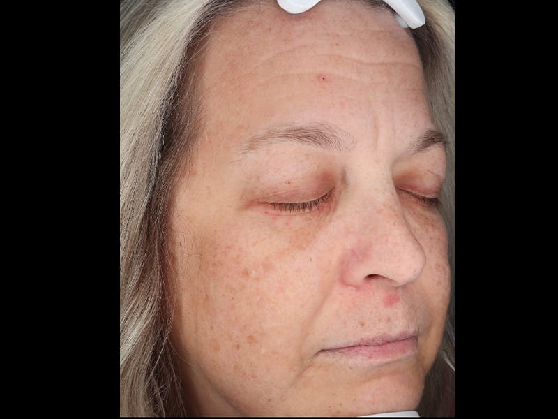 Chemical Peel Before & After Gallery - Patient 367541 - Image 3
