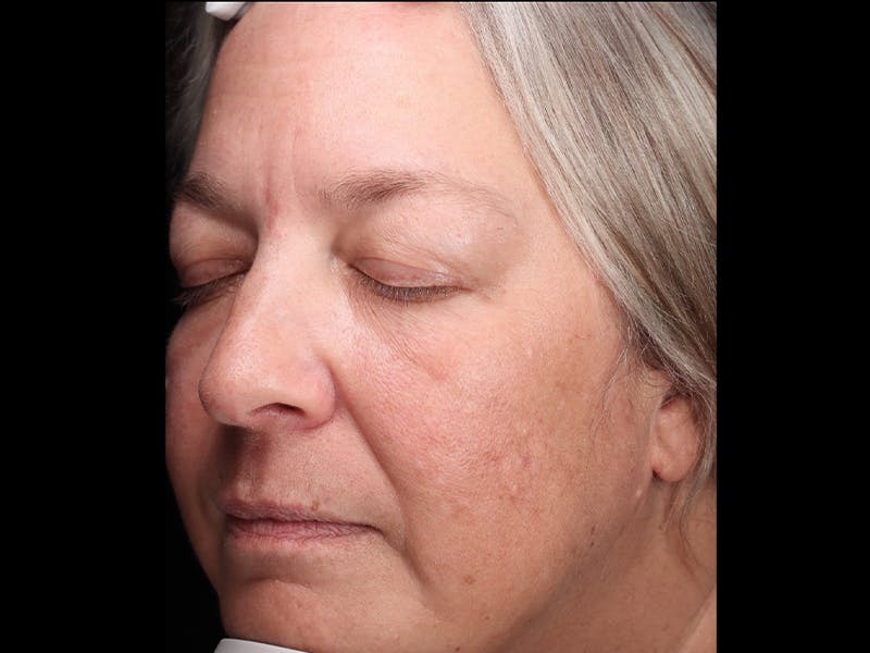 Chemical Peel Before & After Gallery - Patient 367541 - Image 6