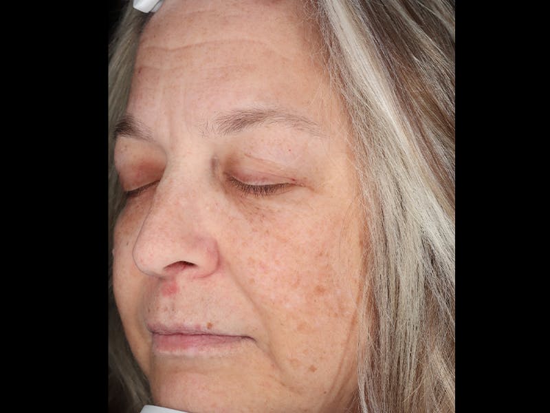 Chemical Peel Before & After Gallery - Patient 367541 - Image 5