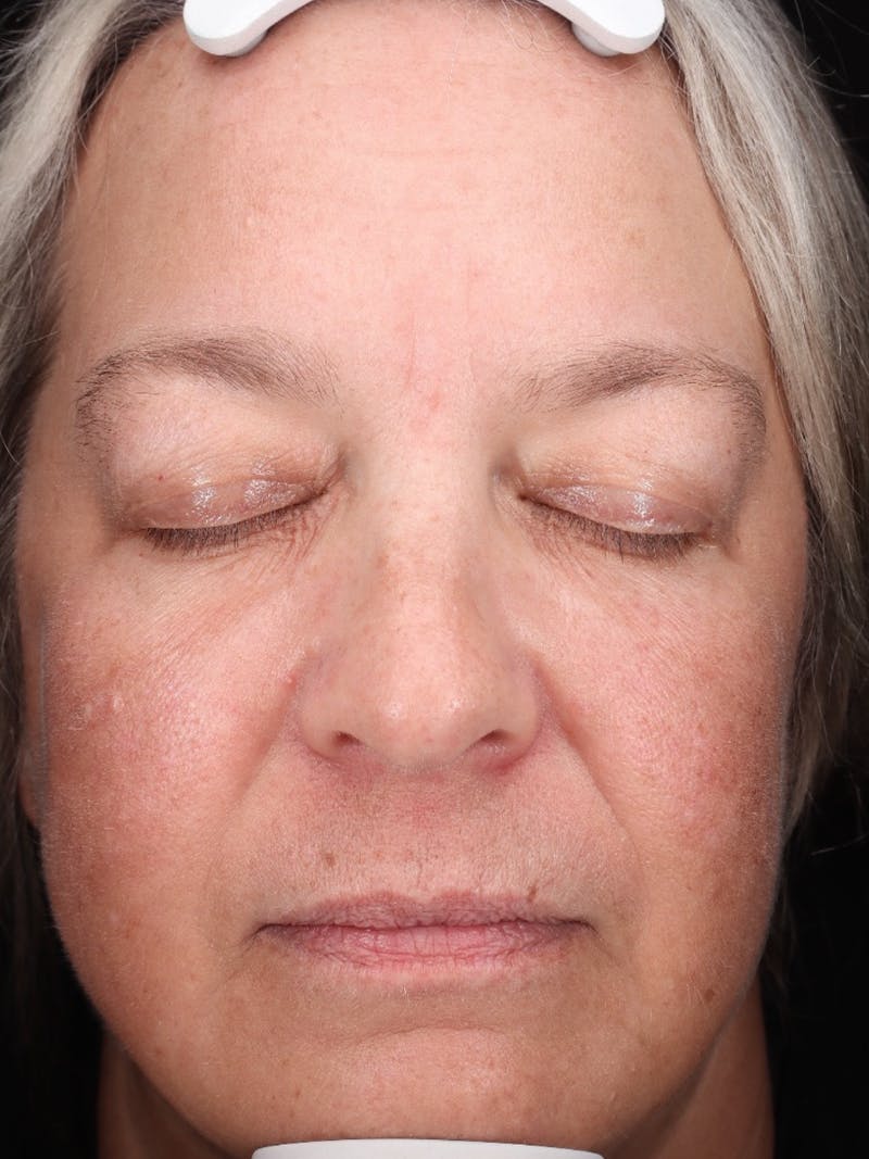 Skin Care Protocol Before & After Gallery - Patient 162332 - Image 2