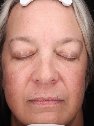 Skin Care Protocol Before & After Gallery - Patient 162332 - Image 2