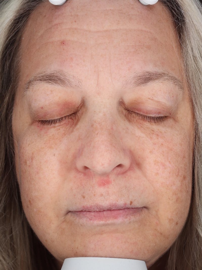 Skin Care Protocol Before & After Gallery - Patient 162332 - Image 1