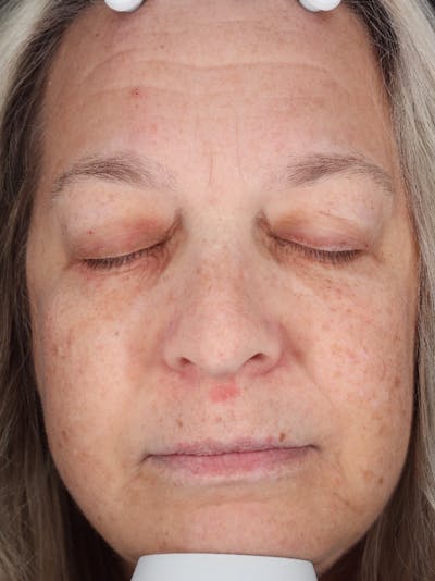 Skin Care Protocol Before & After Gallery - Patient 162332 - Image 1