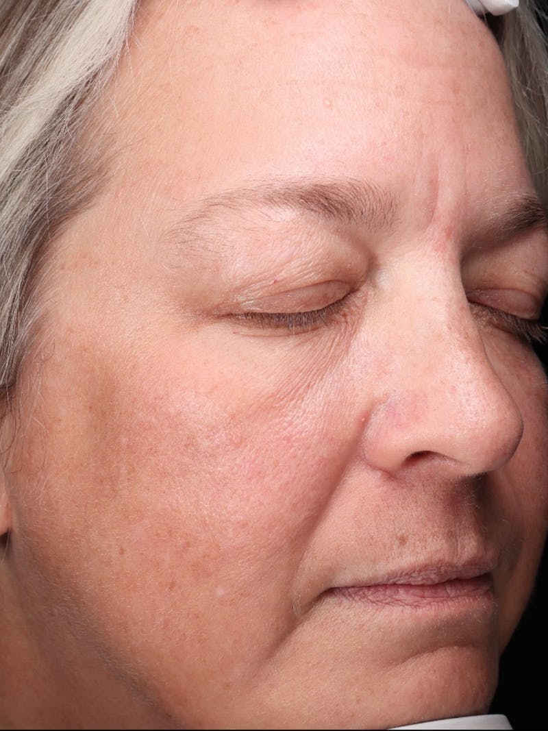 Skin Care Protocol Before & After Gallery - Patient 162332 - Image 3