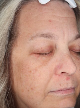 Skin Care Protocol Before & After Gallery - Patient 162332 - Image 4