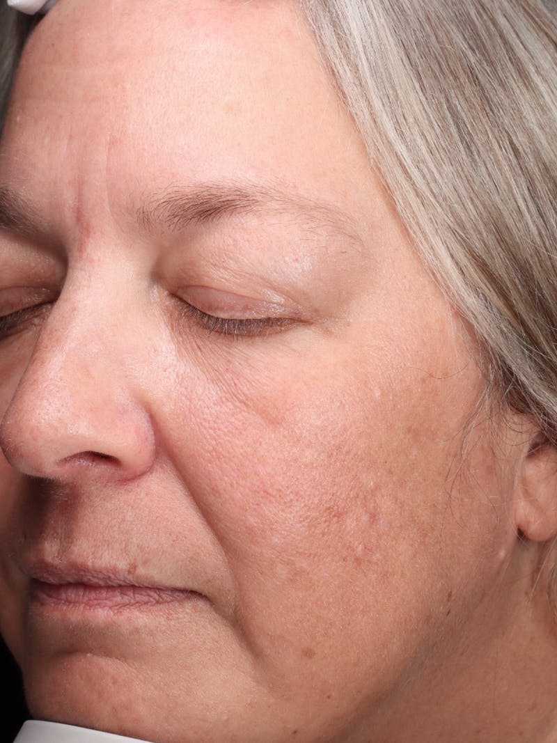 Skin Care Protocol Before & After Gallery - Patient 162332 - Image 5