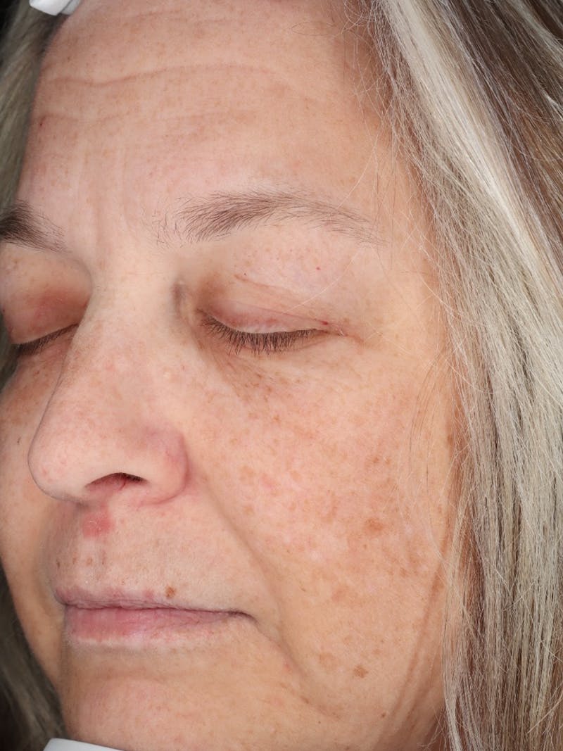 Skin Care Protocol Before & After Gallery - Patient 162332 - Image 6
