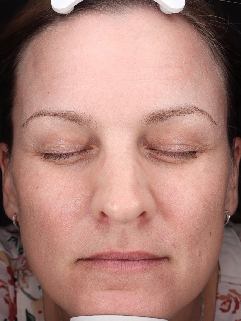 Laser Treatment Before & After Gallery - Patient 366084 - Image 2