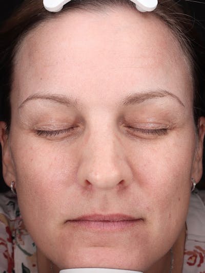 Laser Treatment Before & After Gallery - Patient 366084 - Image 2