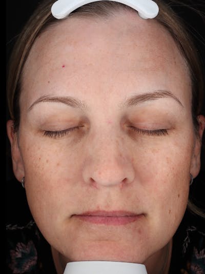 Laser Treatment Before & After Gallery - Patient 366084 - Image 1