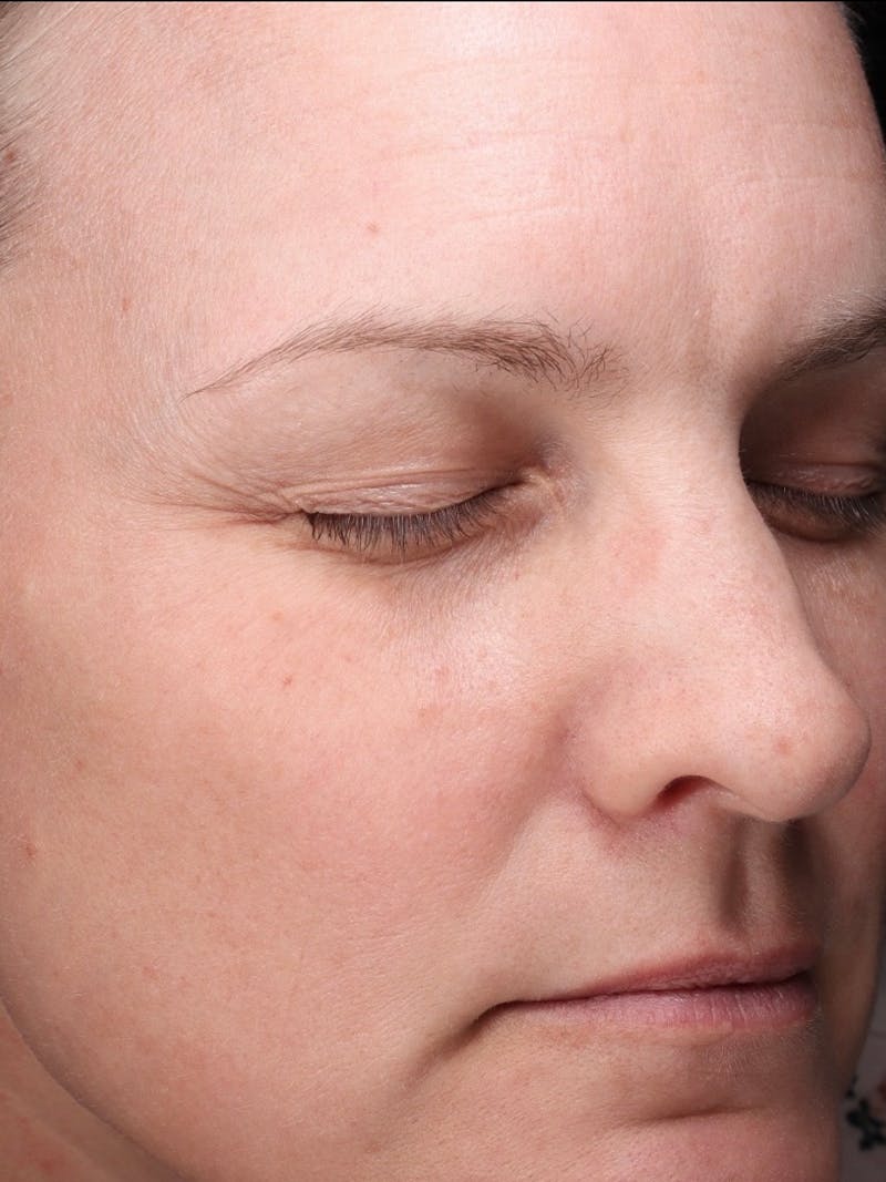 Laser Treatment Before & After Gallery - Patient 366084 - Image 4