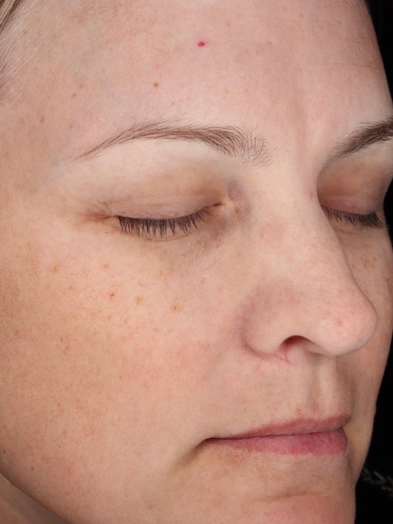 Laser Treatment Before & After Gallery - Patient 366084 - Image 3