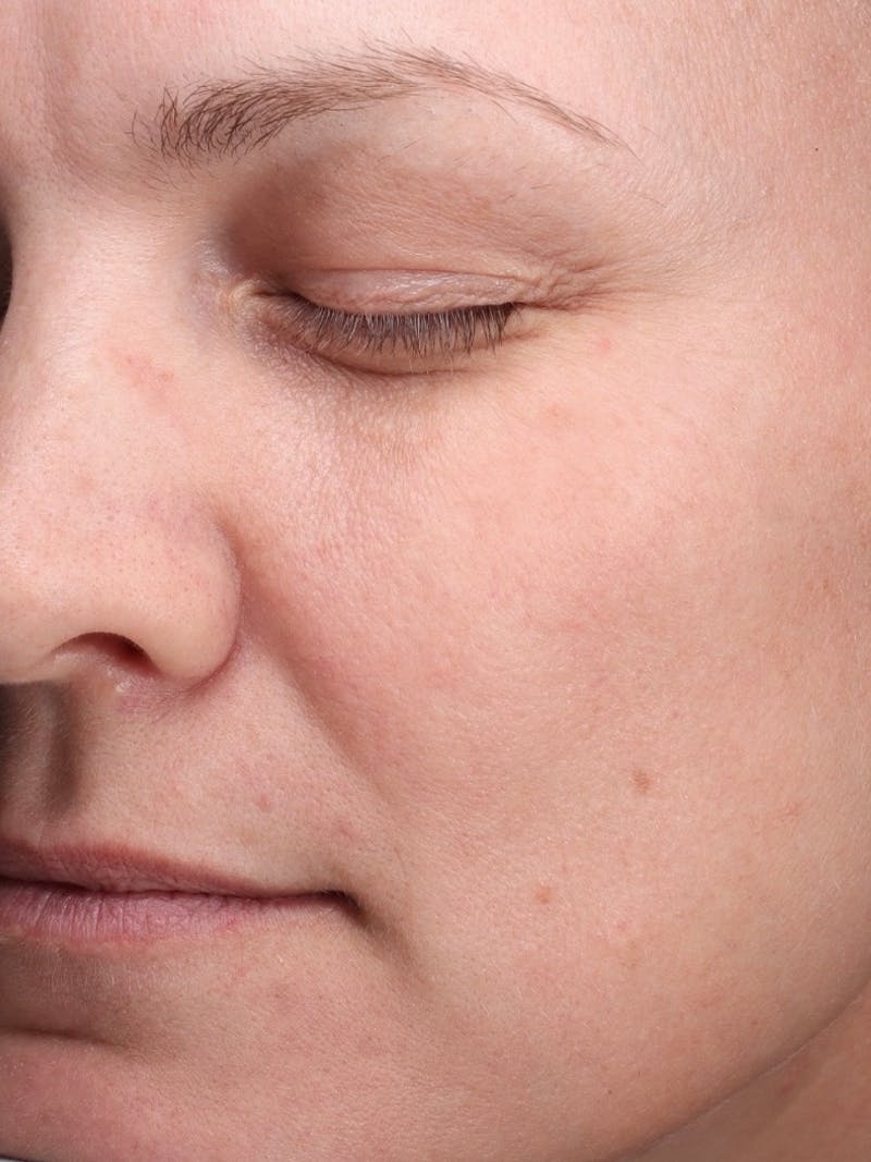 Laser Treatment Before & After Gallery - Patient 366084 - Image 6