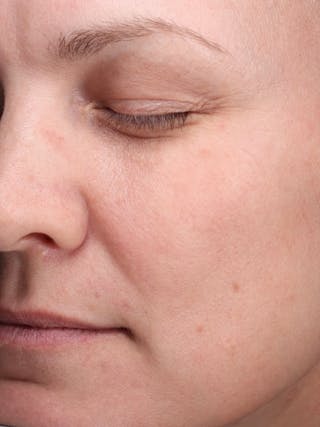 Laser Treatment Before & After Gallery - Patient 366084 - Image 6