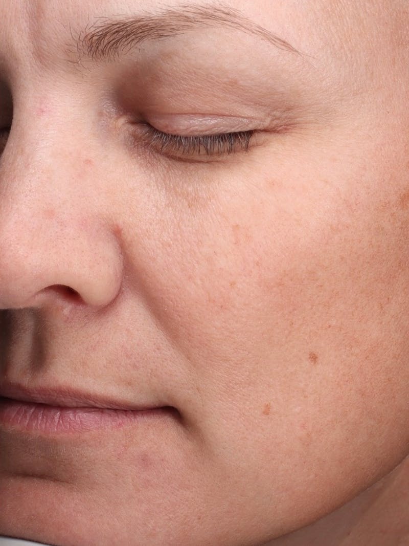 Laser Treatment Before & After Gallery - Patient 366084 - Image 5
