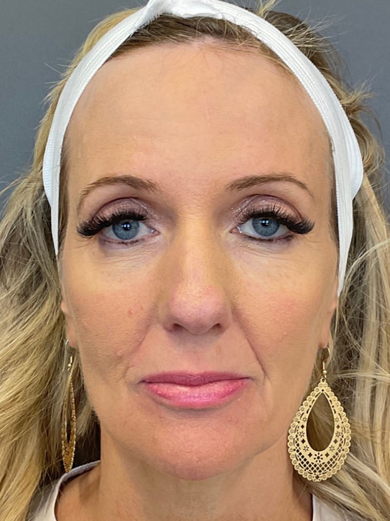 Full Face Rejuvenation Before & After Gallery - Patient 297816 - Image 2