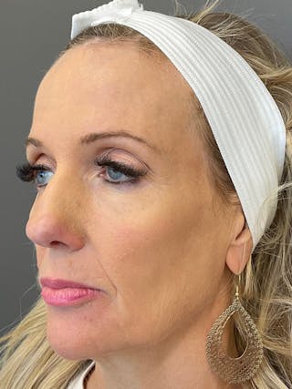 Full Face Rejuvenation Before & After Gallery - Patient 297816 - Image 4