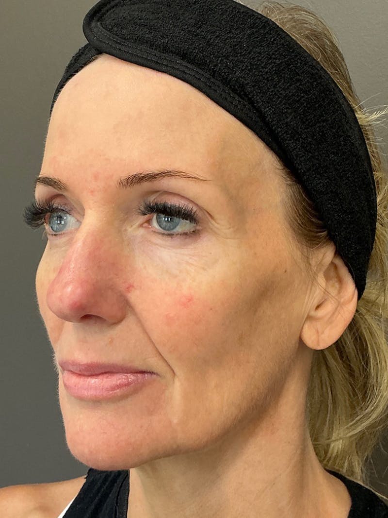 Full Face Rejuvenation Before & After Gallery - Patient 297816 - Image 3