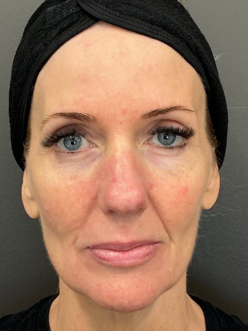 Full Face Rejuvenation Before & After Gallery - Patient 297816 - Image 1