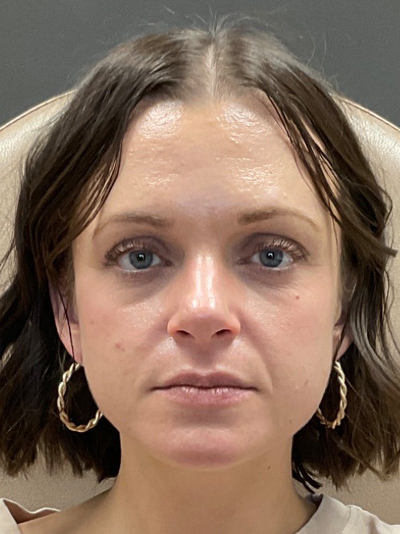 Cheek Filler Before & After Gallery - Patient 297293 - Image 1