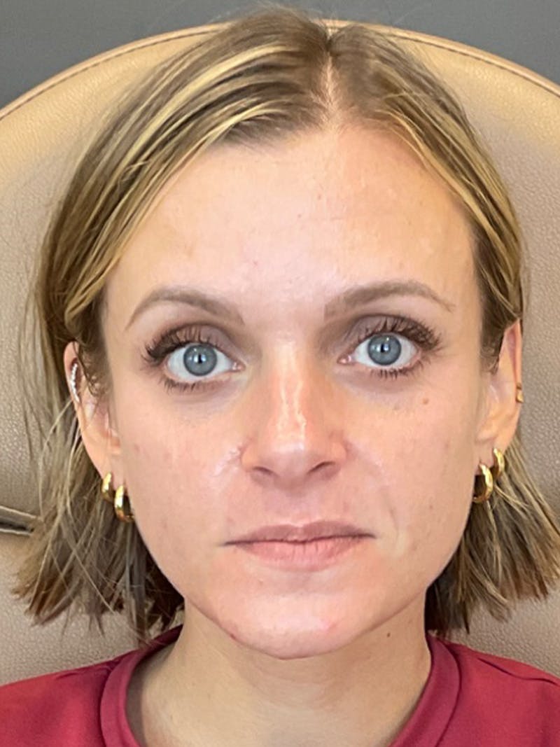 Cheek Filler Before & After Gallery - Patient 297293 - Image 2