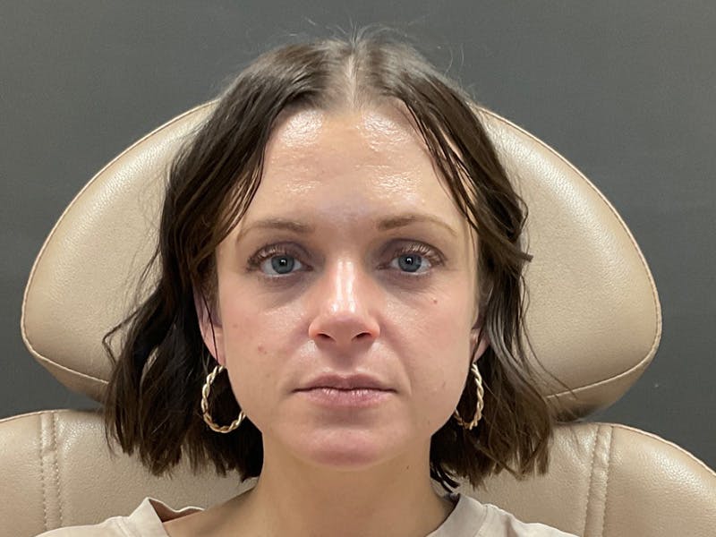 Botox/Dysport Before & After Gallery - Patient 322862 - Image 1