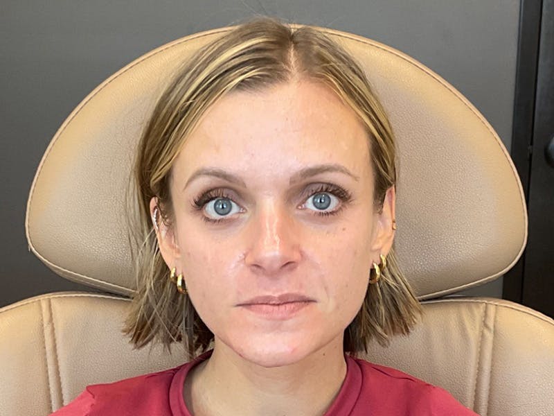 Botox/Dysport Before & After Gallery - Patient 322862 - Image 2