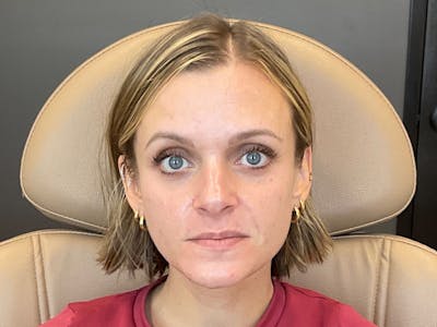 Botox/Dysport Before & After Gallery - Patient 322862 - Image 2