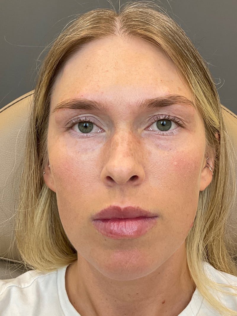 Cheek Filler Before & After Gallery - Patient 232968 - Image 2