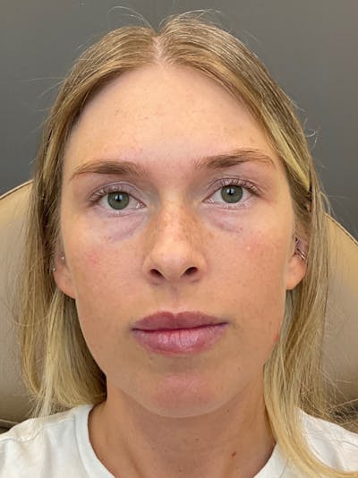 Cheek Filler Before & After Gallery - Patient 232968 - Image 1