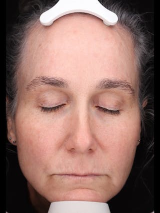 Laser Treatment Before & After Gallery - Patient 150547 - Image 2