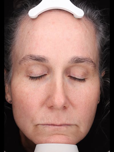 Laser Treatment Before & After Gallery - Patient 150547 - Image 2