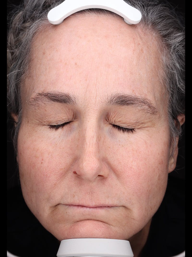 Laser Treatment Before & After Gallery - Patient 150547 - Image 1