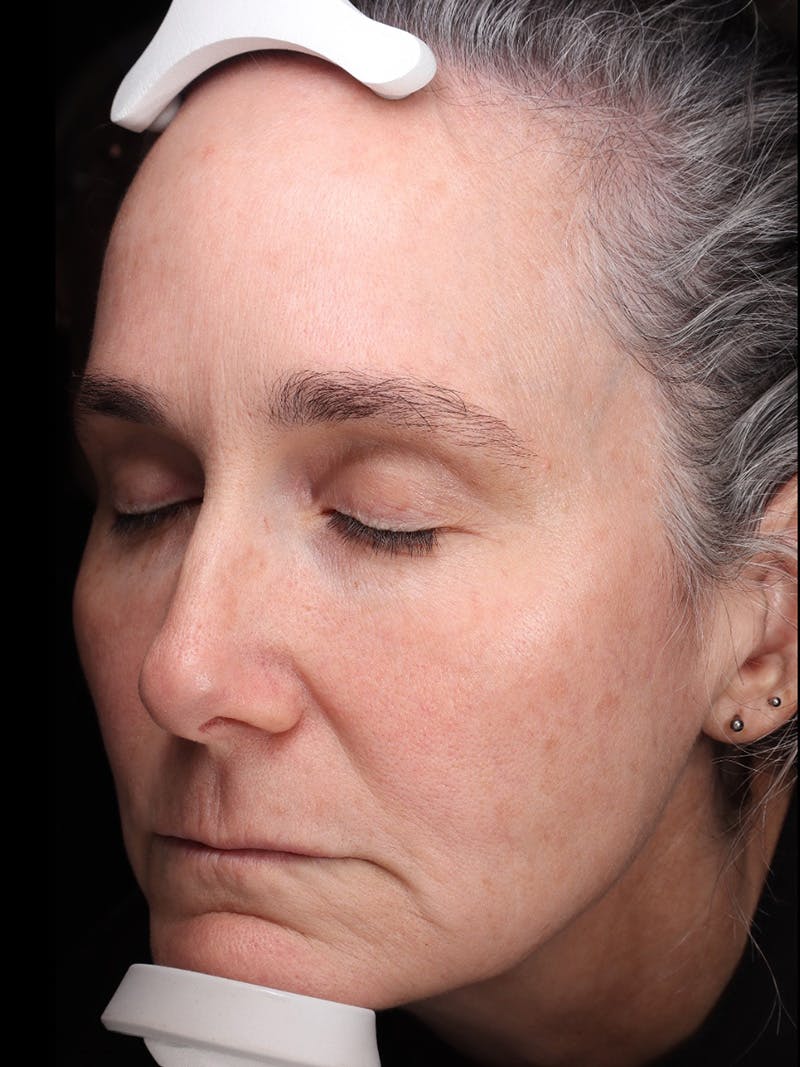 Laser Treatment Before & After Gallery - Patient 150547 - Image 6