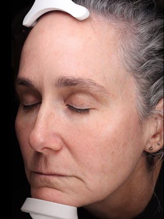 Laser Treatment Before & After Gallery - Patient 150547 - Image 6