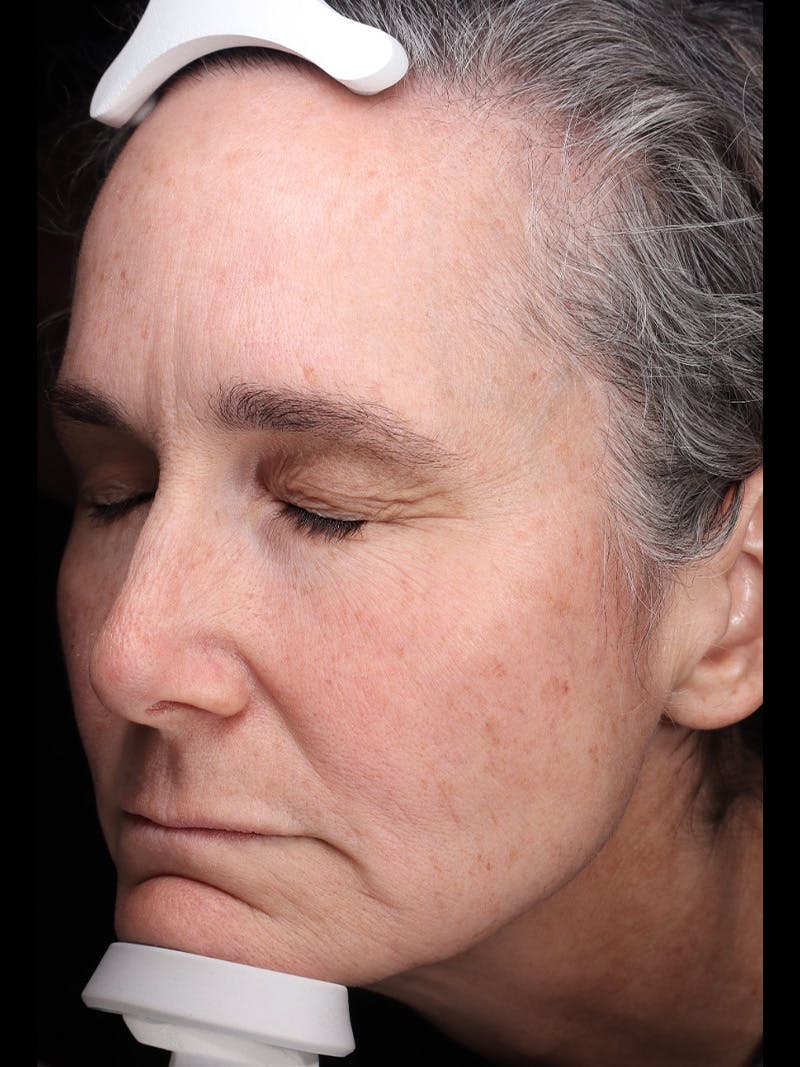 Laser Treatment Before & After Gallery - Patient 150547 - Image 5