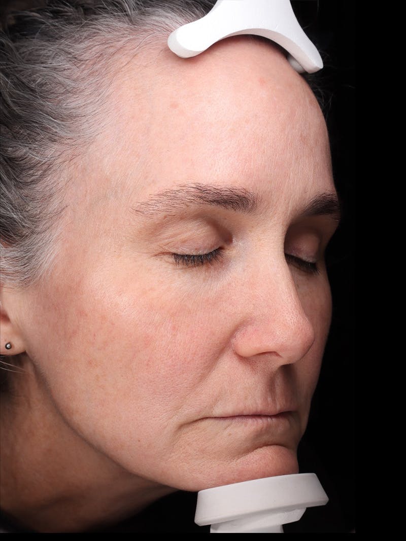 Laser Treatment Before & After Gallery - Patient 150547 - Image 4