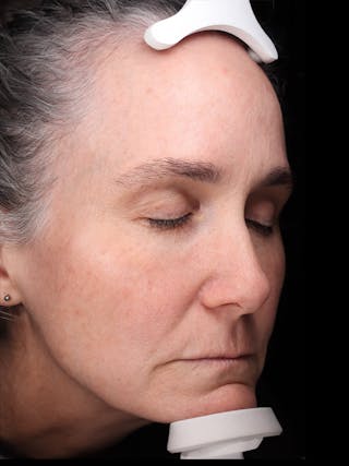 Laser Treatment Before & After Gallery - Patient 150547 - Image 4