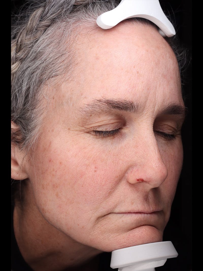 Laser Treatment Before & After Gallery - Patient 150547 - Image 3