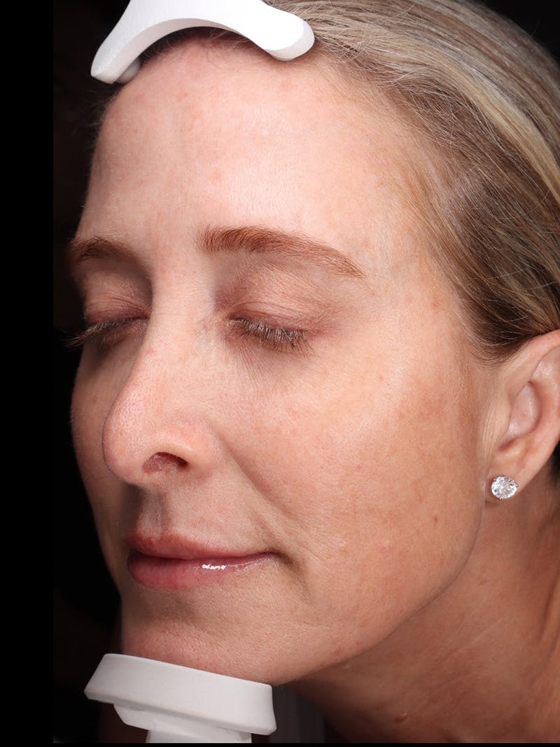 Laser Treatment Before & After Gallery - Patient 898866 - Image 6