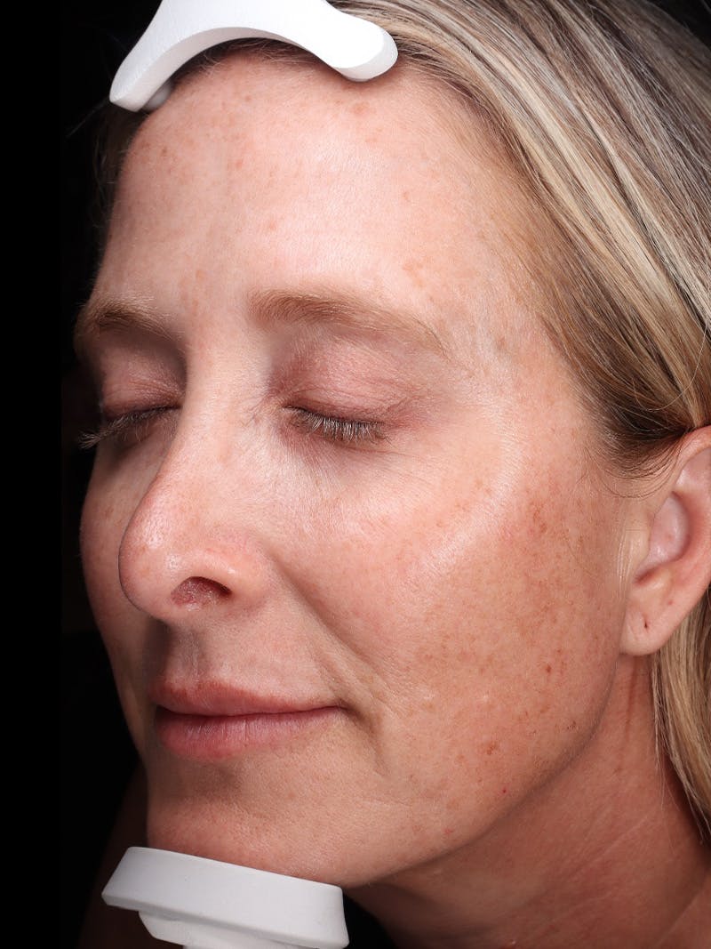 Laser Treatment Before & After Gallery - Patient 898866 - Image 5