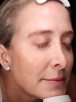 Laser Treatment Before & After Gallery - Patient 898866 - Image 4