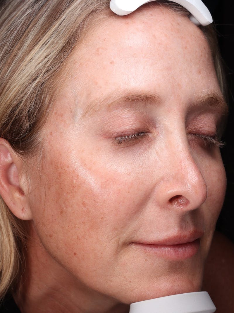Laser Treatment Before & After Gallery - Patient 898866 - Image 3
