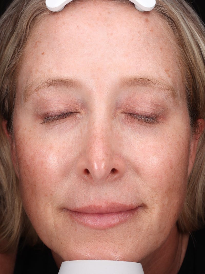 Laser Treatment Before & After Gallery - Patient 898866 - Image 1