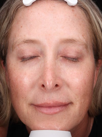 Laser Treatment Before & After Gallery - Patient 898866 - Image 1
