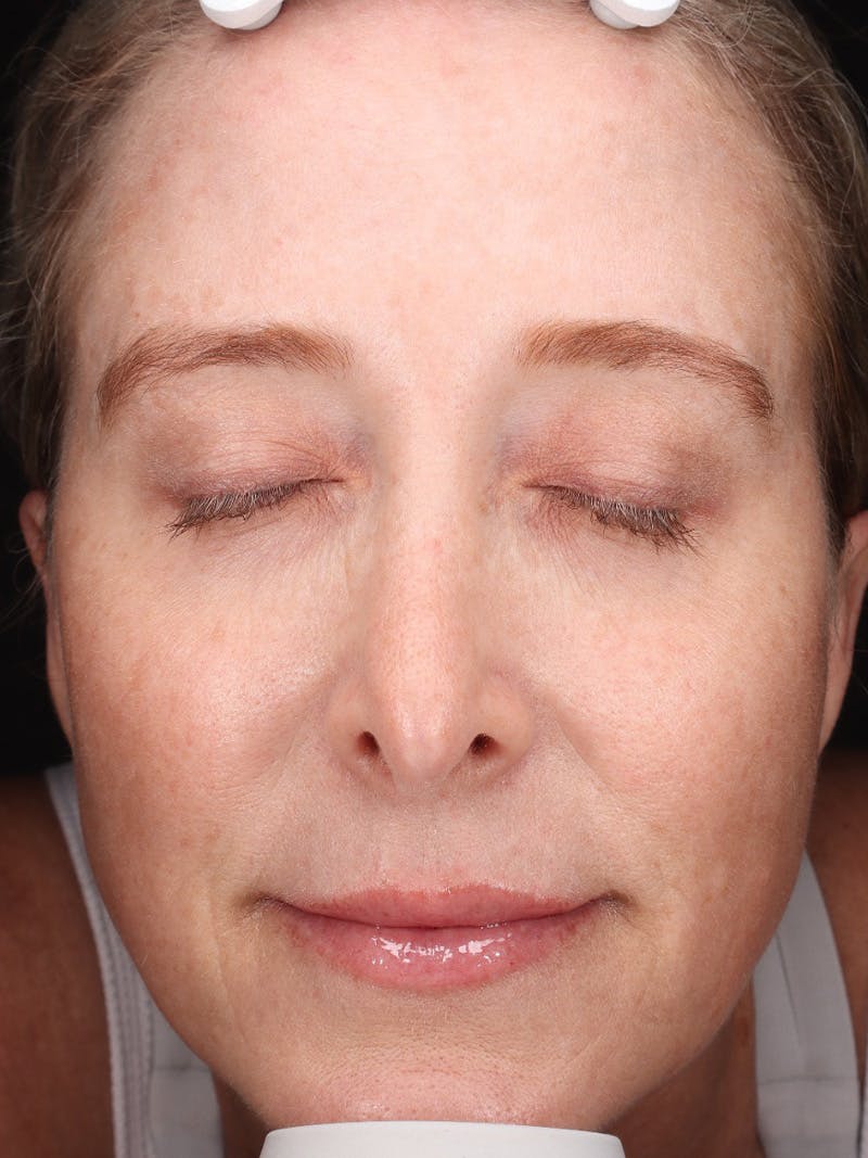 Laser Treatment Before & After Gallery - Patient 898866 - Image 2