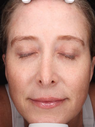 Laser Treatment Before & After Gallery - Patient 898866 - Image 2