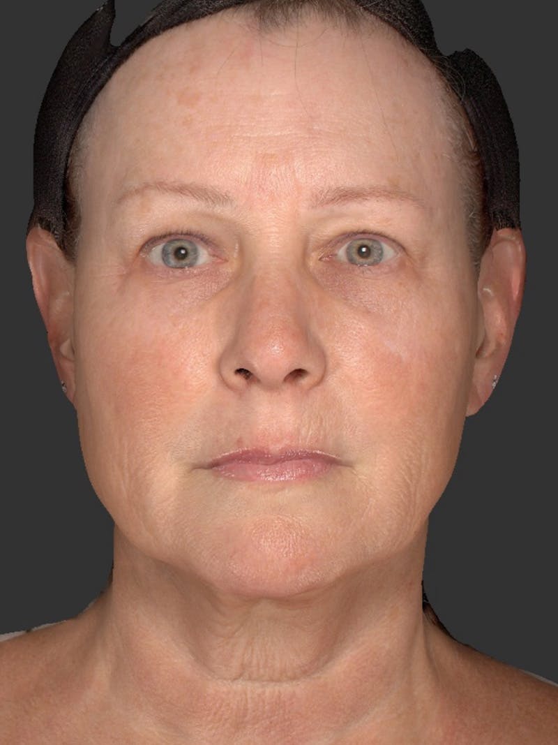 AURI Sculpt & Restore Before & After Gallery - Patient 286828 - Image 2