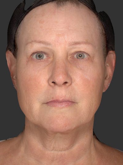 AURI Sculpt & Restore Before & After Gallery - Patient 286828 - Image 2